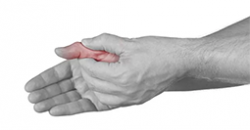 Артроз суставов пальцев рук