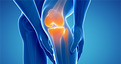 Деформирующий остеоартроз суставов ног