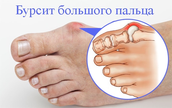 Бурсит пятки лечение народными средствами. Пяточный бурсит: правильное лечение, симптомы и диагностика, терапия. Бурсит пятки: причины, симптомы и лечение Бурсит пятки: что это такое, симптомы и лечение